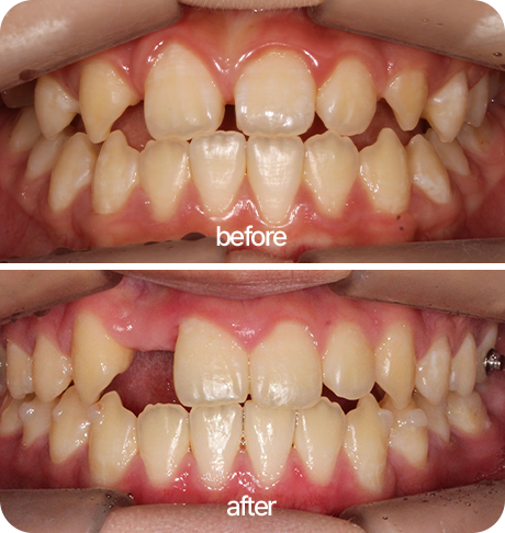 인비절라인(투명교정)을 이용한 임플란트 수복공간 형성 및 교합개선