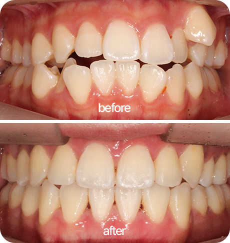 덧니 및 교차교합 개선을 위한 발치교정