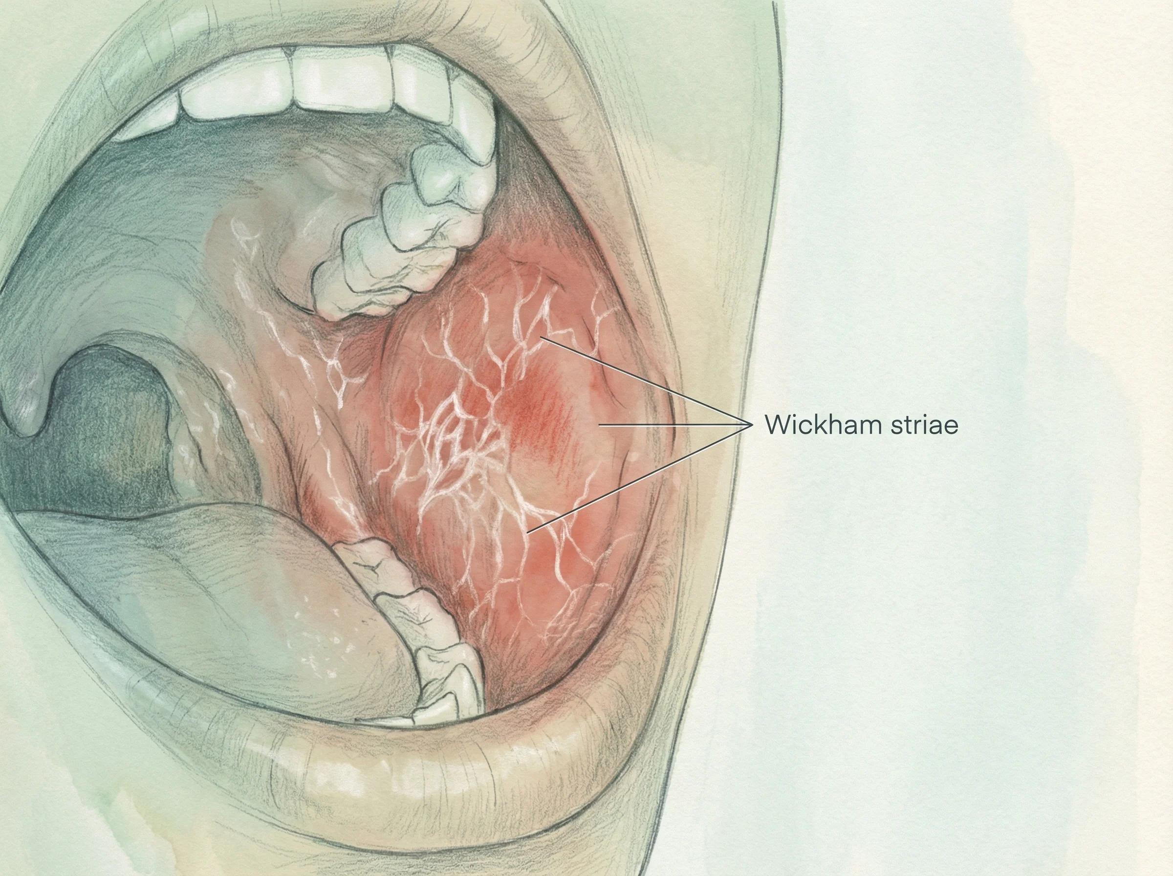구강 편평태선(Oral Lichen Planus)