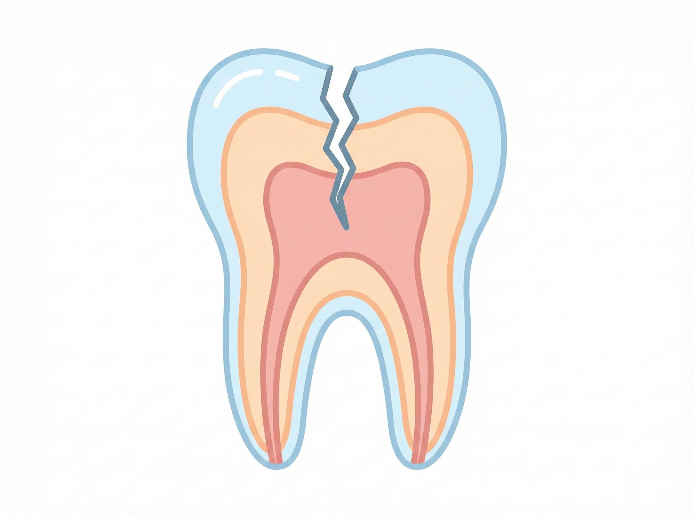 치아 파절과 균열(Cracked Tooth)