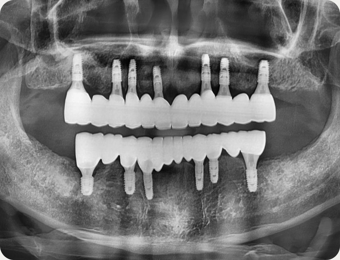 치료 전후 X-ray 비교 — 치료 후