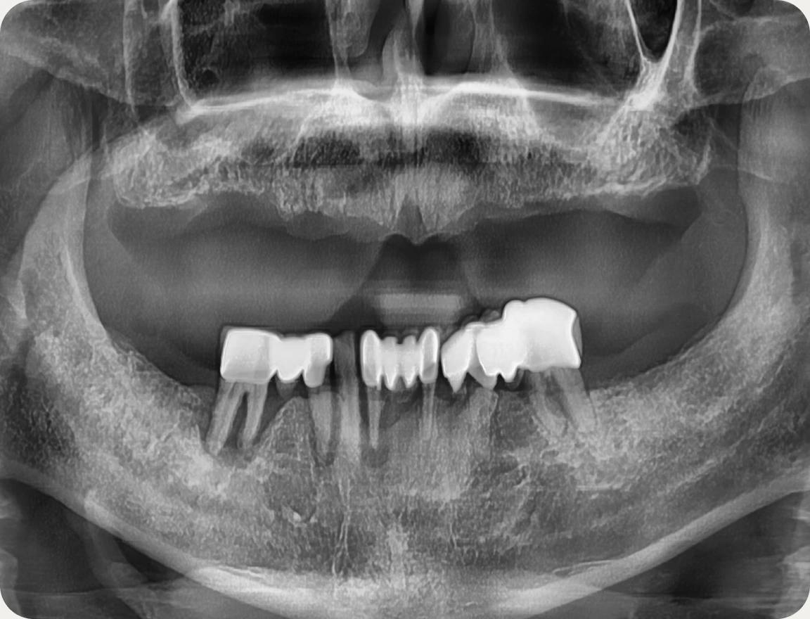 치료 전후 X-ray 비교 — 치료 전