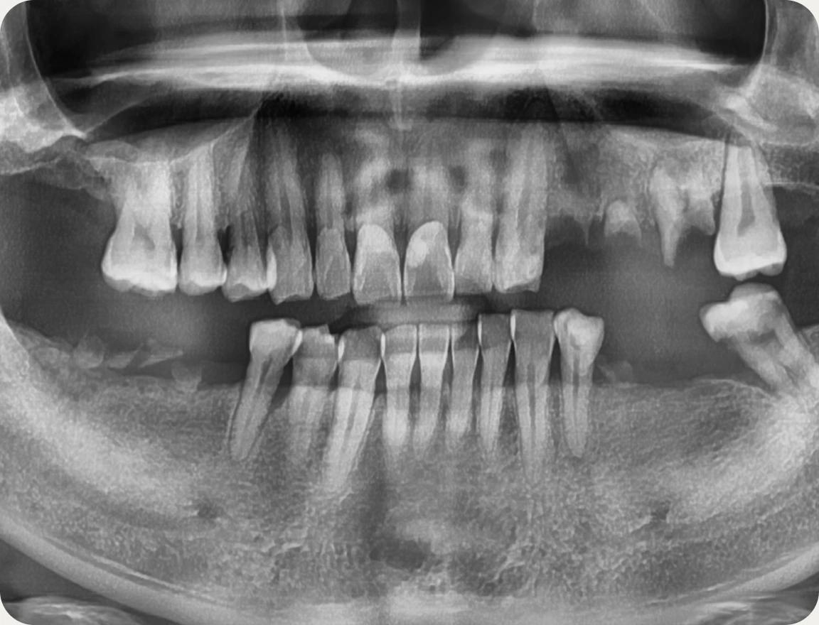 치료 전후 X-ray 비교 — 치료 전