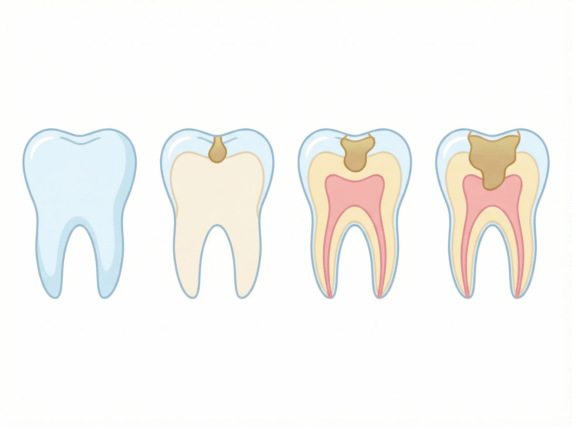 충치(Dental Caries)