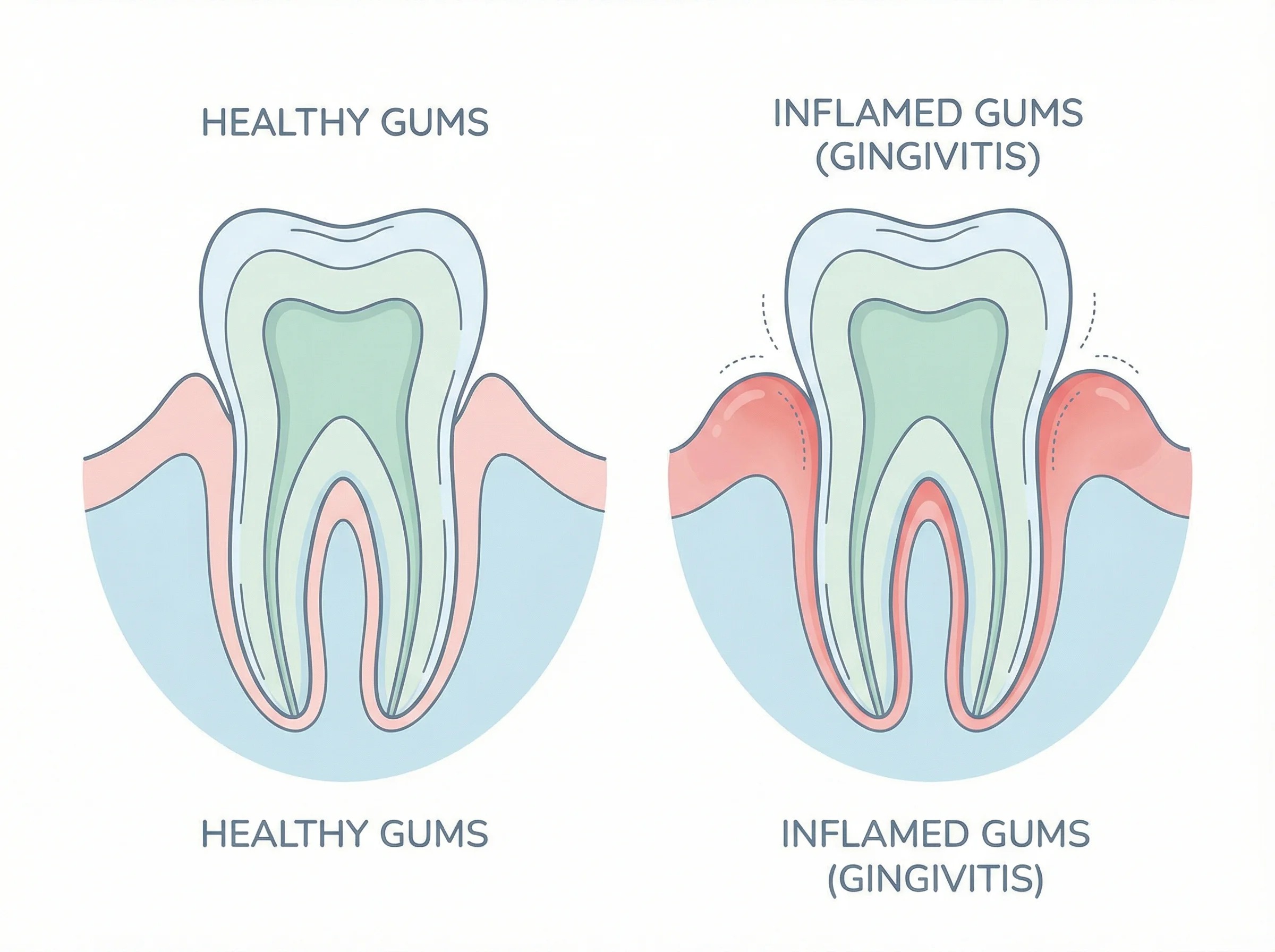 치은염(Gingivitis)