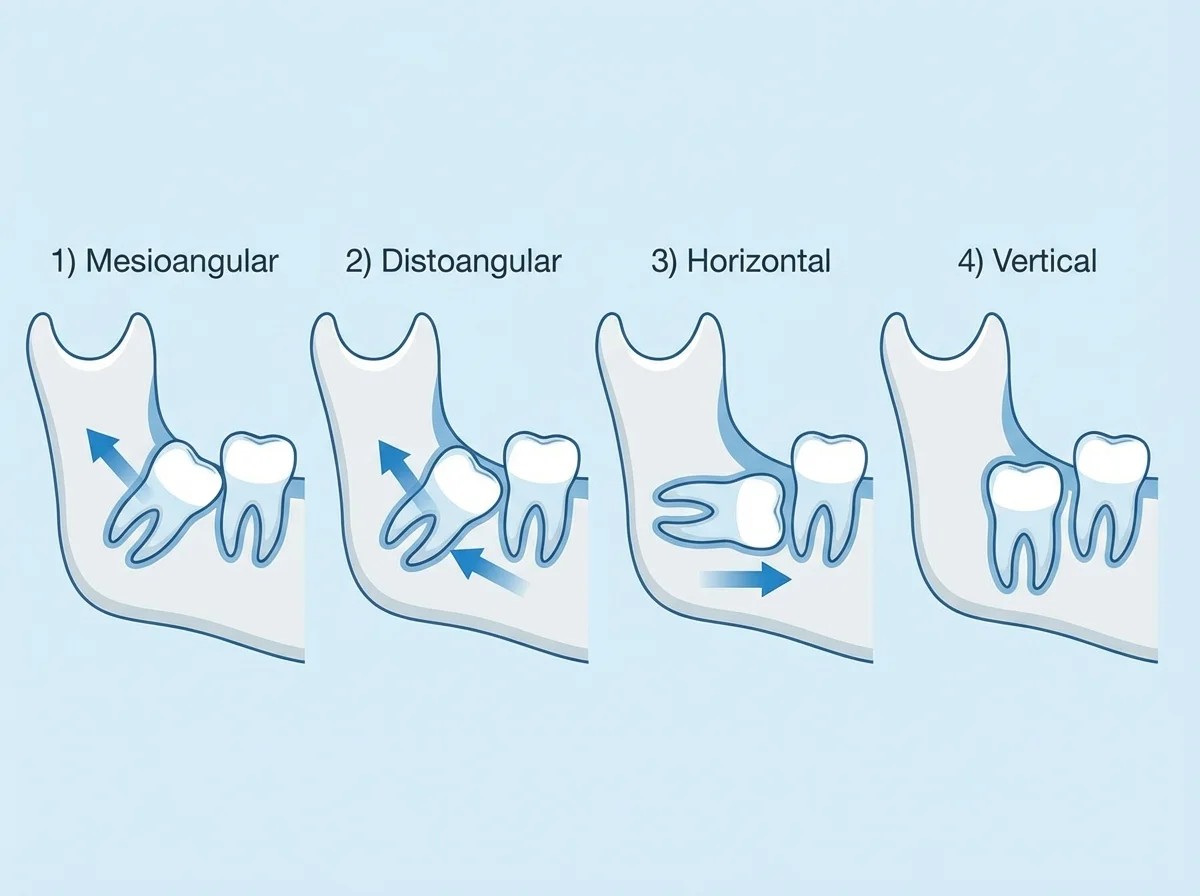 매복 사랑니(Impacted Wisdom Teeth)