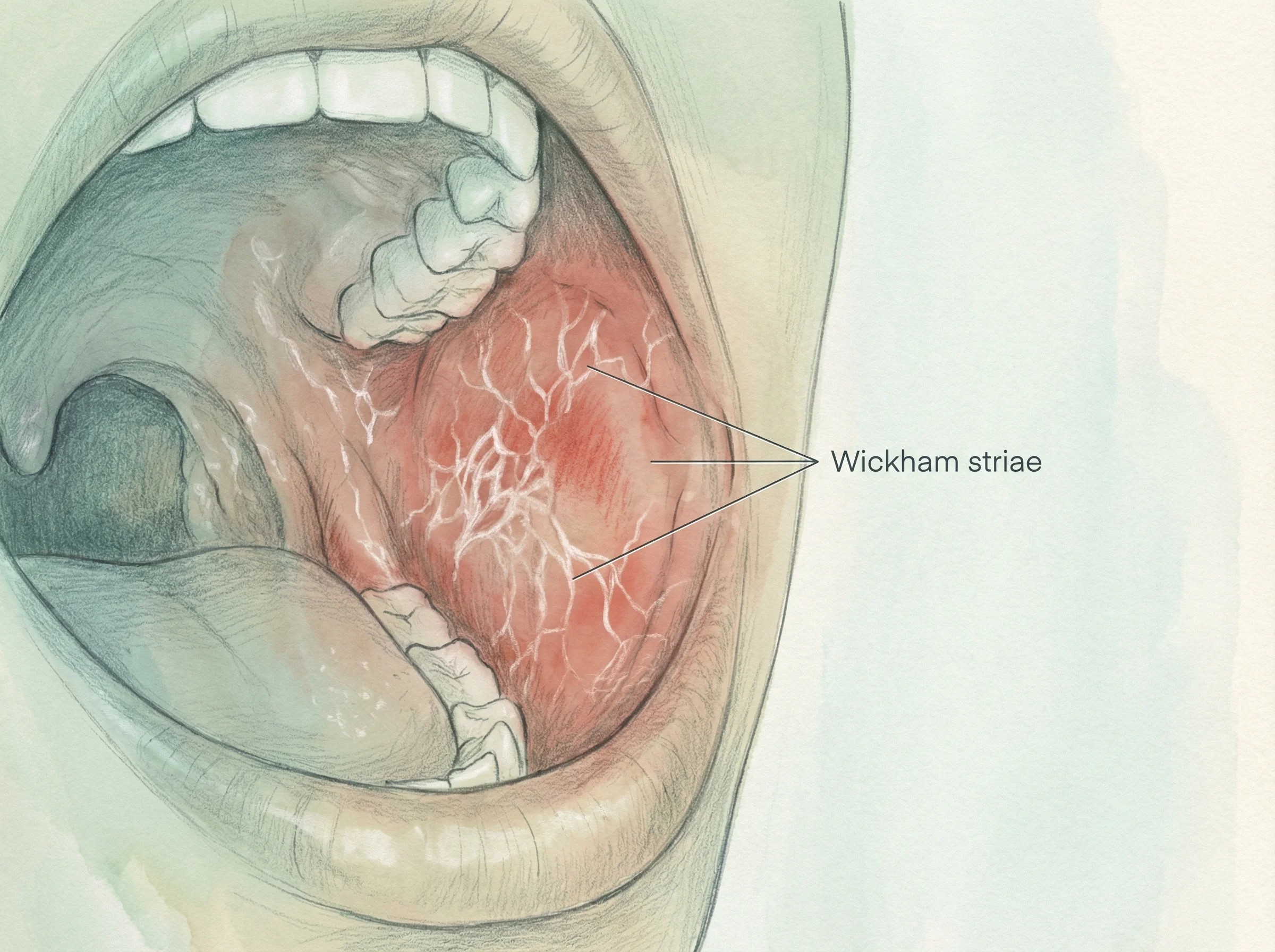 구강 편평태선(Oral Lichen Planus)