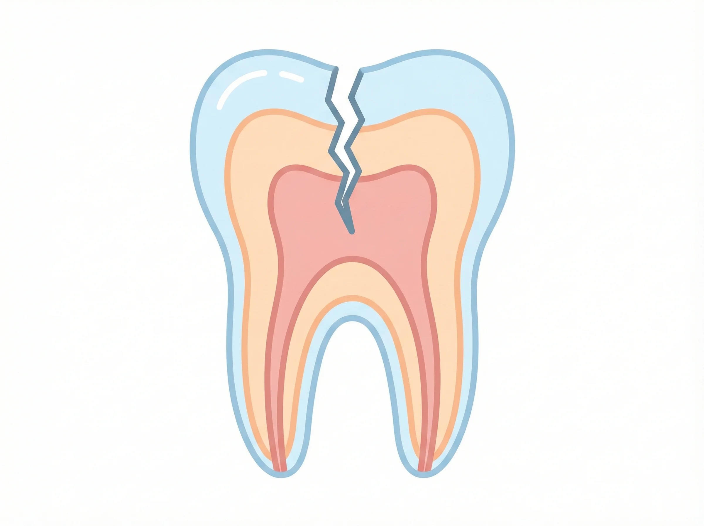 치아 파절과 균열(Cracked Tooth)