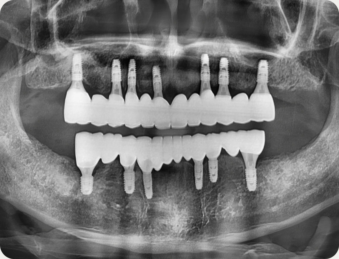 치료 전후 X-ray 비교