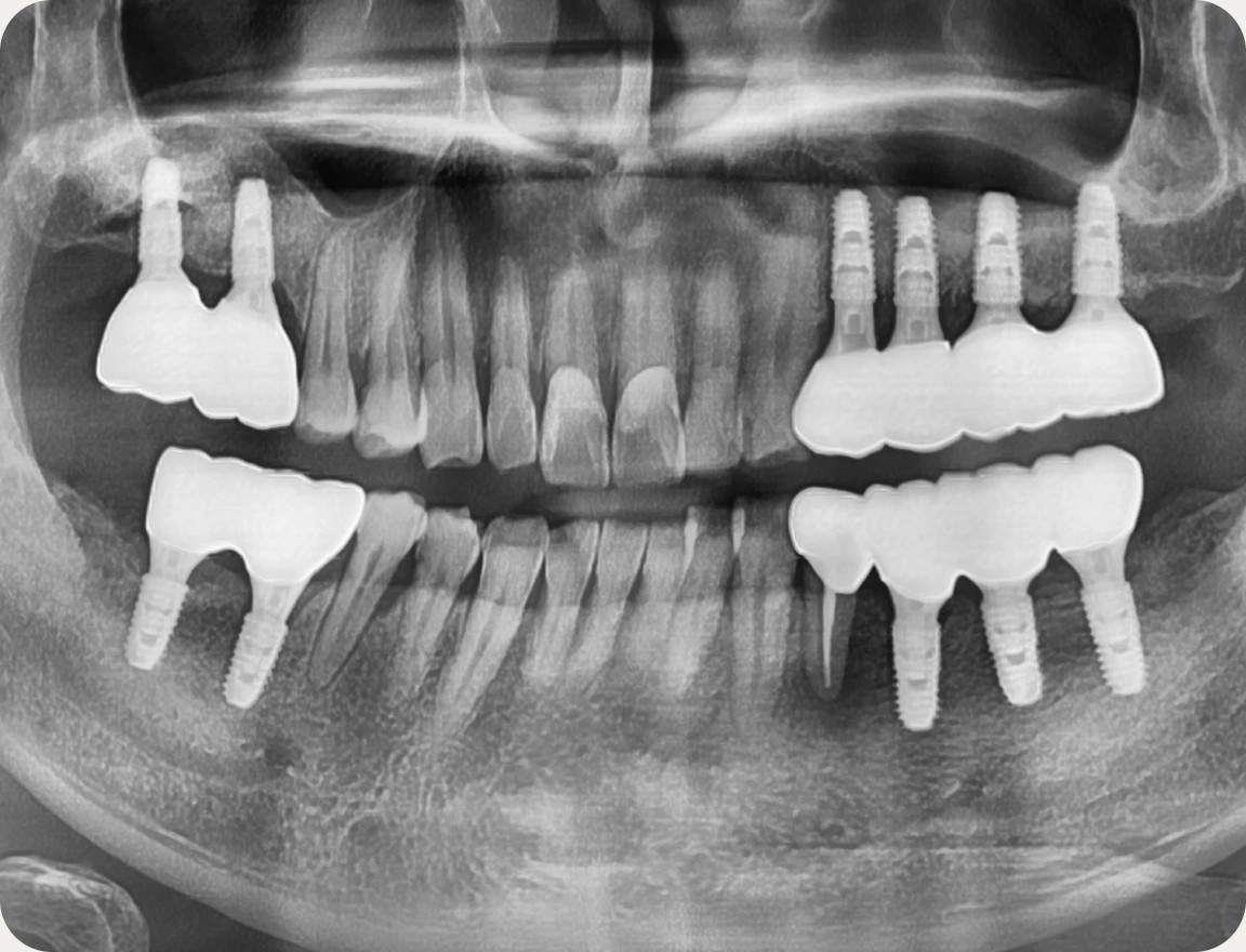 치료 전후 X-ray 비교
