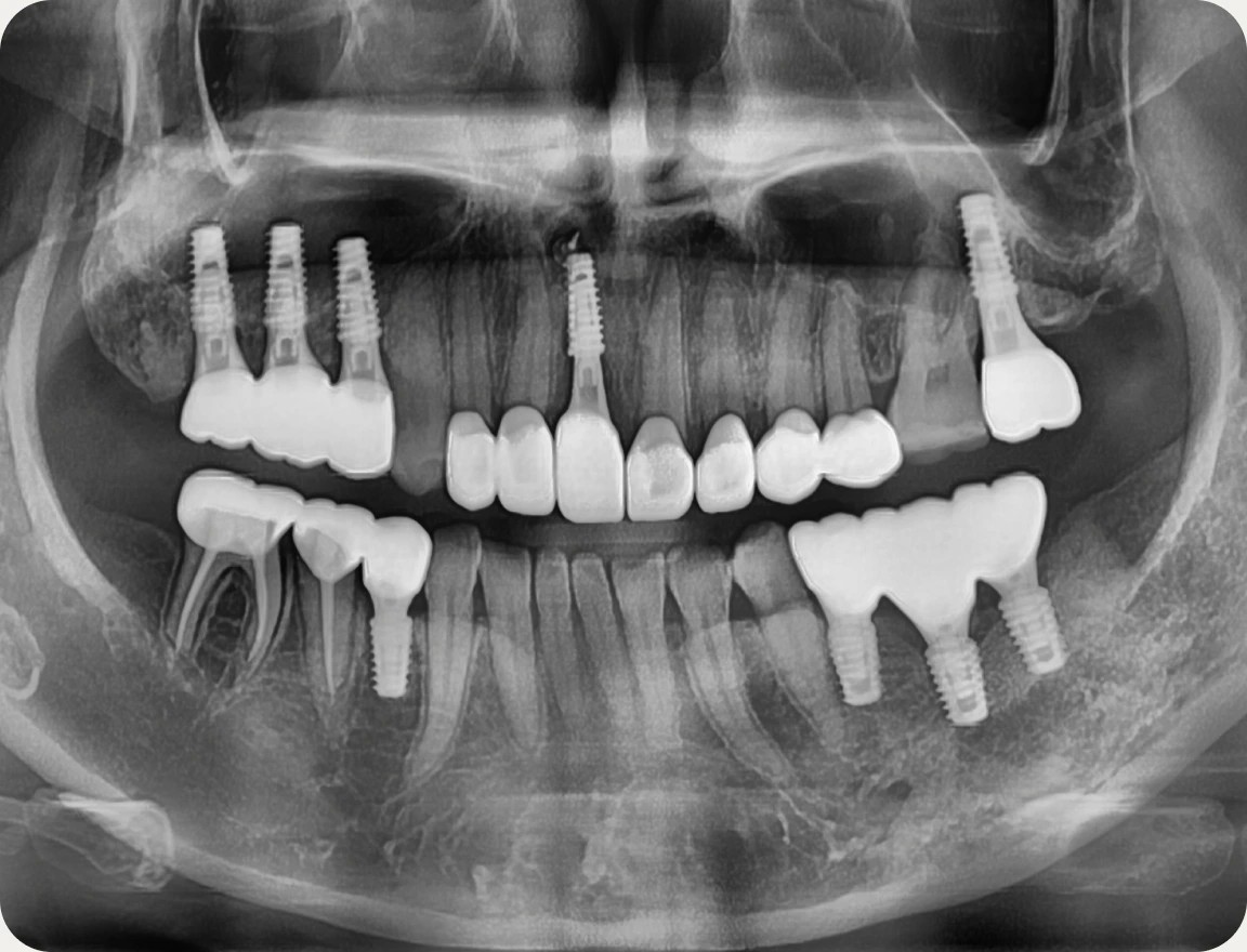 파노라마 X-ray 치료 전후 비교