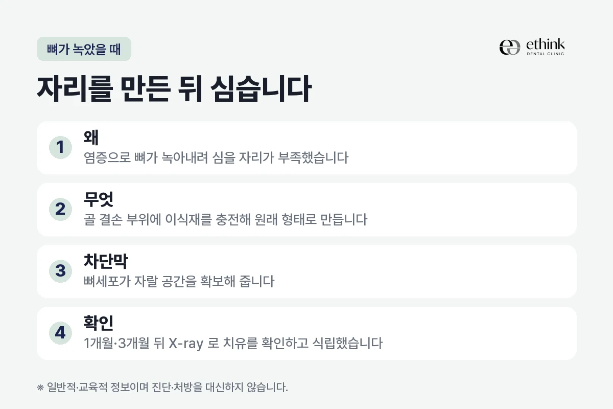 염증으로 뼈가 녹은 자리에 골유도재생술을 거쳐 임플란트를 심는 순서를 정리한 도해