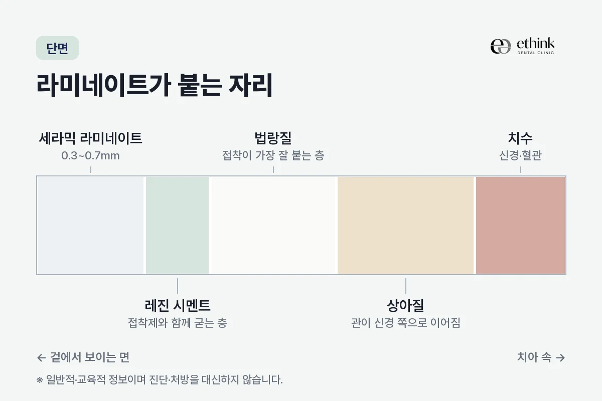 세라믹 라미네이트와 레진 시멘트, 법랑질, 상아질, 치수의 순서를 가로로 늘어놓은 단면 도해