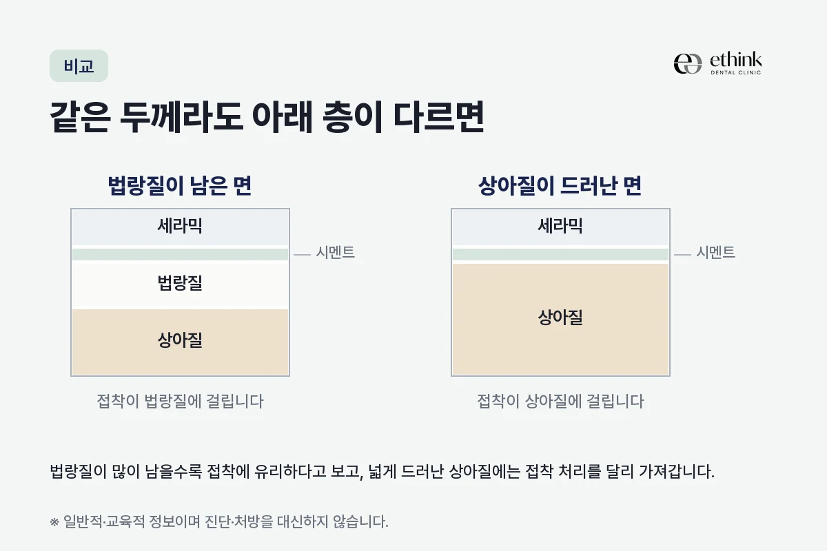 법랑질이 남은 면과 상아질이 드러난 면에 같은 두께의 라미네이트가 붙는 모습을 나란히 놓은 단면 비교 도해