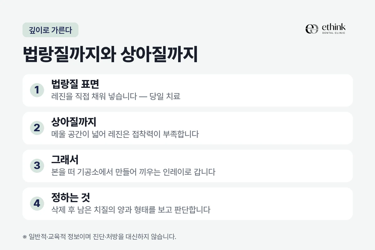 충치 깊이에 따라 레진과 인레이가 갈리는 기준을 정리한 도해