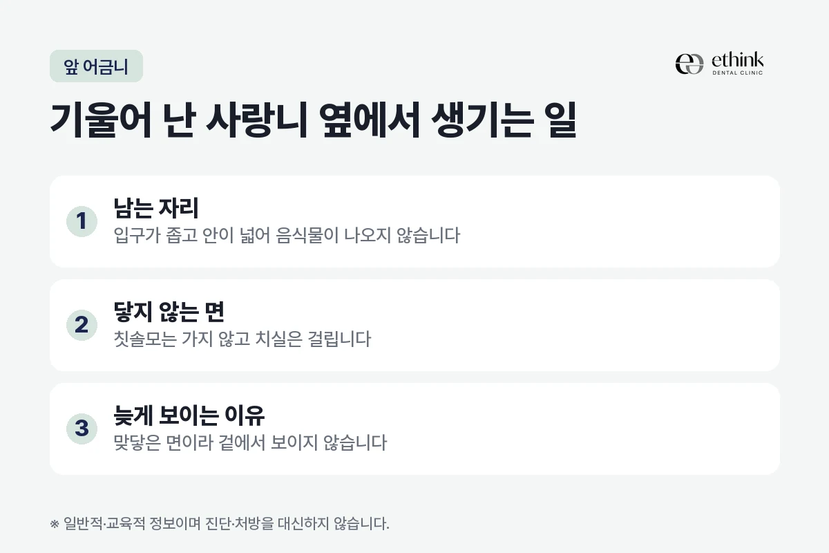 기울어 난 사랑니와 앞 어금니 사이에 음식물이 남고 칫솔이 닿지 않아 뒷면이 먼저 썩는 과정을 정리한 도해
