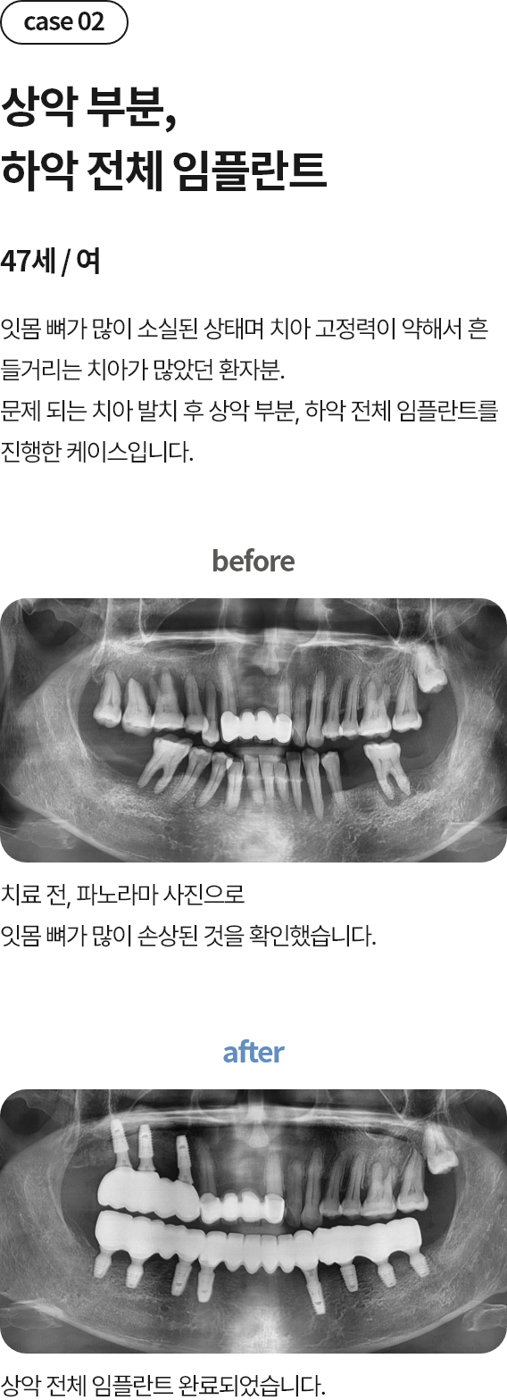 평촌에서 임플란트 병원 찾는다면 꼭 확인하세요 3가지 3