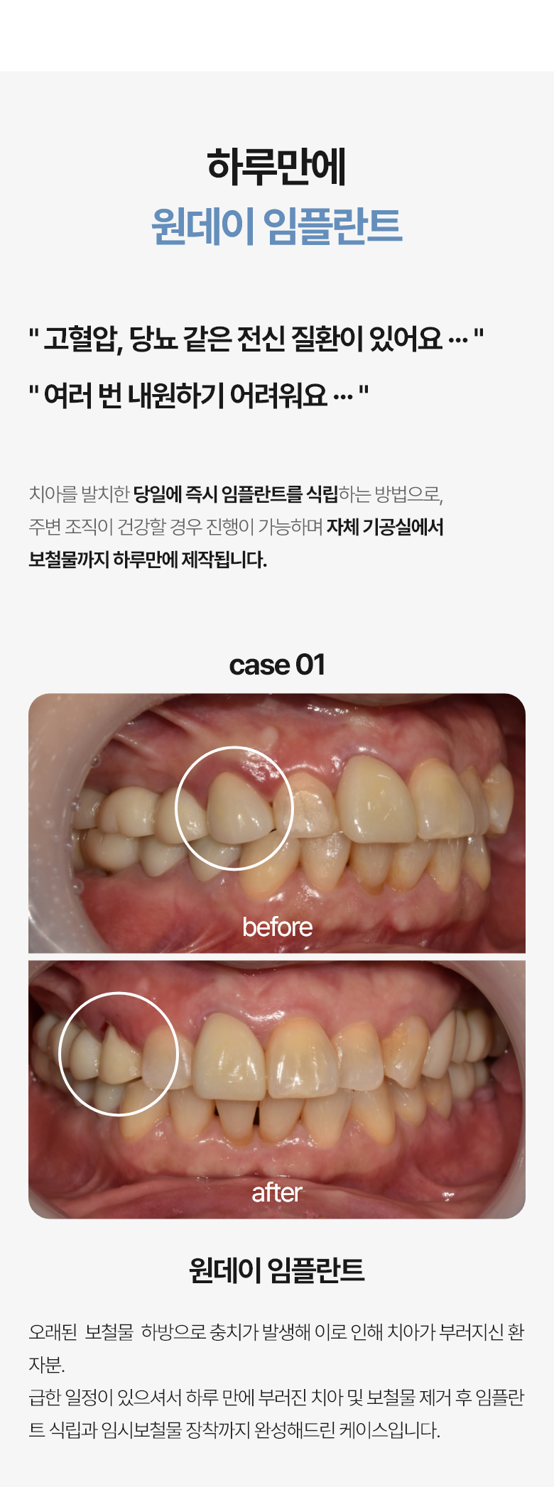 평촌에서 임플란트 병원 찾는다면 꼭 확인하세요 3가지 4