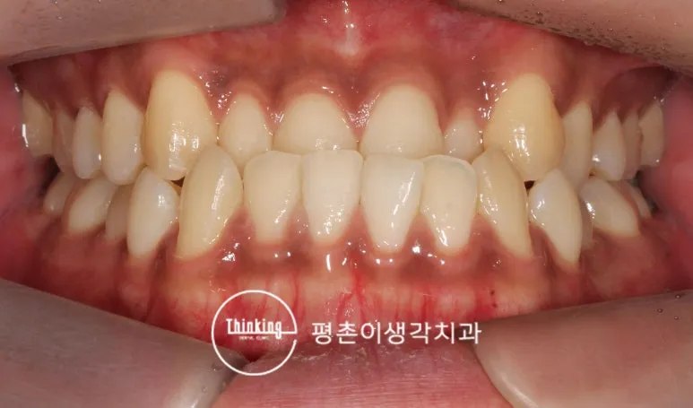 성인 반대교합 교정 전 앞니가 거꾸로 물리는 정면 모습