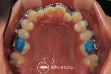 어금니 씹는 면에 올린 파란색 바이트레진