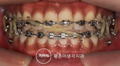 위아래 교정장치를 연결한 악간고무줄 정면 착용 모습