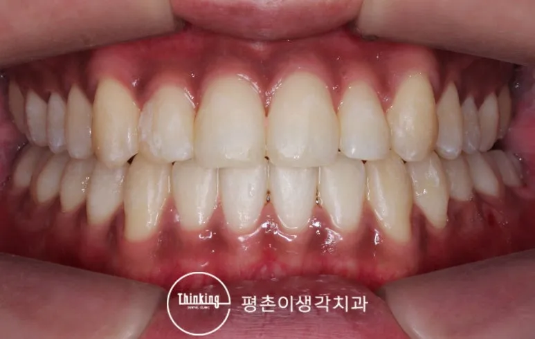 교정 후 위아래 앞니가 정상적으로 맞물리는 정면 모습
