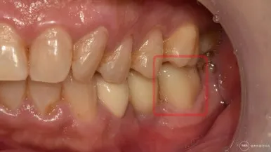 어금니 부위를 옆에서 촬영한 치료 전 구내 사진으로 문제가 된 치아를 빨간 사각형으로 표시한 모습