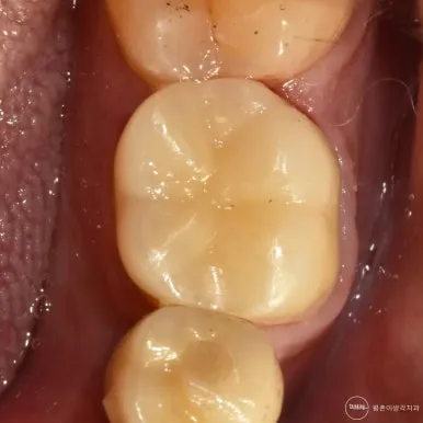 지르코니아 크라운으로 수복을 마친 어금니를 씹는 면에서 촬영한 치료 후 근접 구내 사진