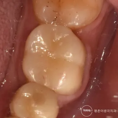 크라운을 장착한 어금니와 앞뒤 인접 치아가 자연스럽게 이어지는지 각도를 바꿔 확인한 구내 사진