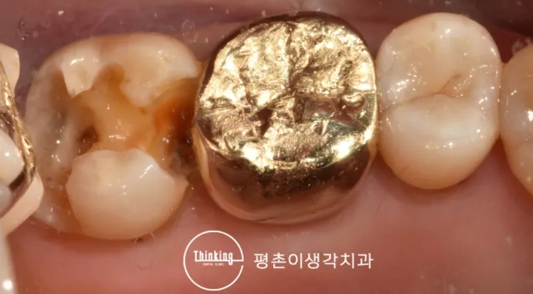 아말감을 제거한 뒤 드러난 치아 내부의 이차충치 구강 사진