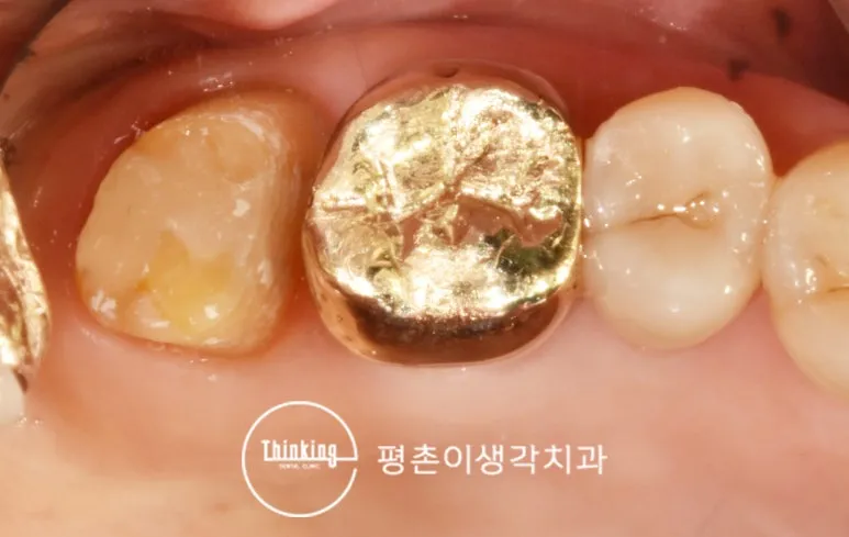 충치를 정리하고 크라운을 위해 형태를 다듬은 어금니 구강 사진