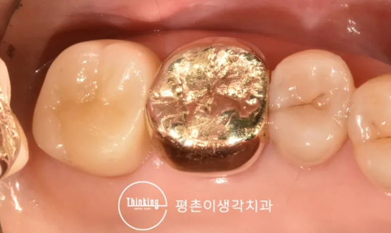 지르코니아 크라운으로 수복을 마친 어금니 구강 사진