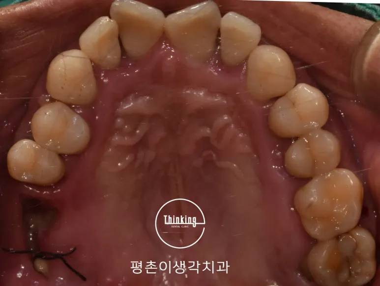 치료 전 위턱을 교합면에서 촬영한 구내 사진으로 양쪽 어금니에 오래된 보철물과 마모된 치아가 남아 있는 상태