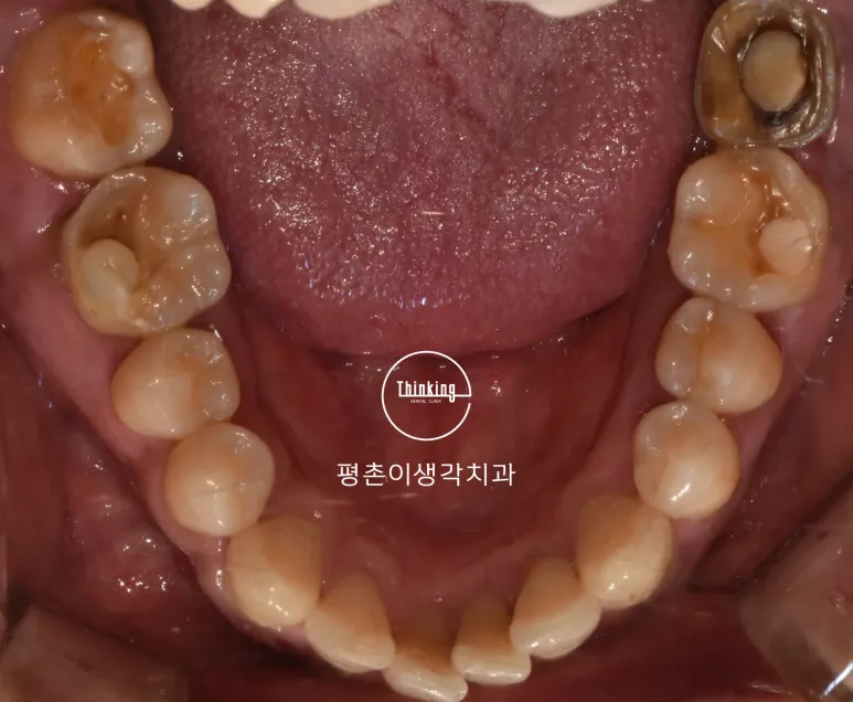 치료 전 아래턱을 교합면에서 본 구내 사진으로 한쪽에는 금속 보철물이 반대쪽에는 크게 손상된 어금니가 보이는 상태