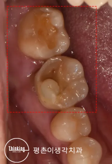빨간 점선으로 표시한 아래 어금니 근접 구내 사진으로 오래된 수복물이 닳고 씹는 면이 깊게 파여 있는 모습