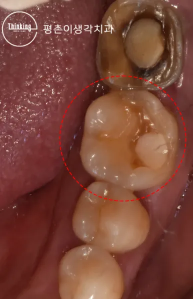금색 금속 크라운 옆 아래 어금니를 빨간 원으로 표시한 근접 구내 사진으로 치아 일부가 깨져 나간 상태