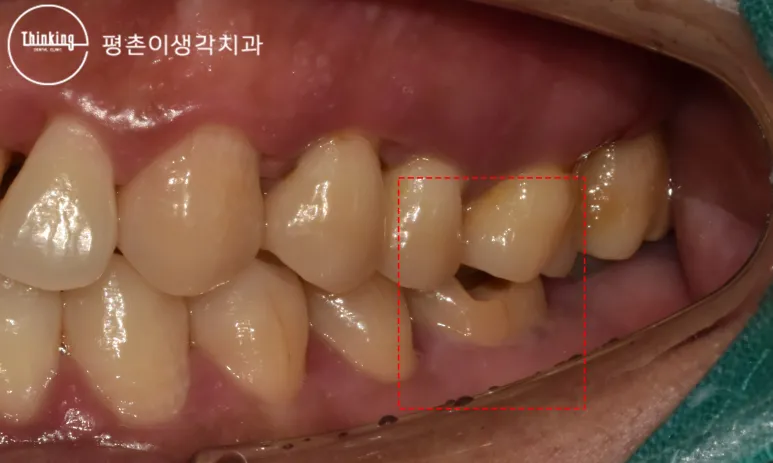 옆에서 촬영한 구내 사진으로 빨간 사각형 안 아래 어금니의 치관 일부가 무너져 잇몸 쪽까지 파인 것이 보이는 모습