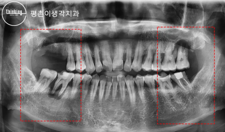 치료 전 파노라마 방사선 사진으로 양쪽 위아래 어금니 부위를 빨간 사각형으로 표시해 결손과 뼈 소실을 보여 주는 모습