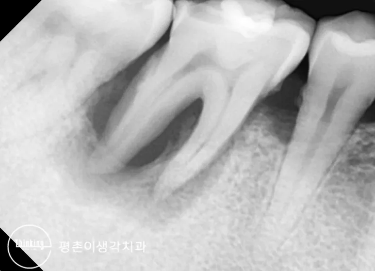 아래 어금니를 찍은 치근단 방사선 사진으로 뿌리 끝과 뿌리 사이에 검게 보이는 염증 음영이 넓게 퍼져 있는 모습