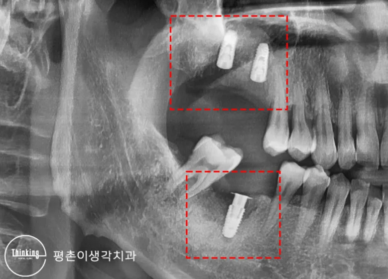 임플란트 식립 직후 방사선 사진으로 위턱 두 개와 아래턱 한 개의 고정체를 빨간 사각형으로 표시한 모습