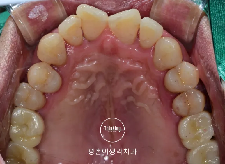 치료를 마친 위턱 교합면 구내 사진으로 양쪽 어금니 자리에 새 보철물이 채워져 치열이 고르게 정리된 모습