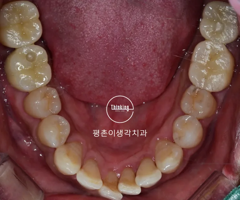 치료를 마친 아래턱 교합면 구내 사진으로 양쪽 어금니 자리에 임플란트 보철물과 크라운이 자리 잡은 모습
