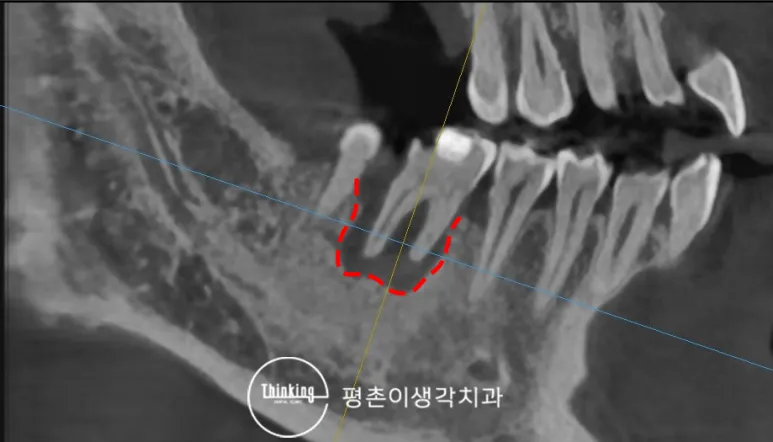 CT 단면 영상에서 아래 어금니 뿌리 주변을 빨간 점선으로 표시해 치조골이 녹아 내린 범위를 보여 주는 모습