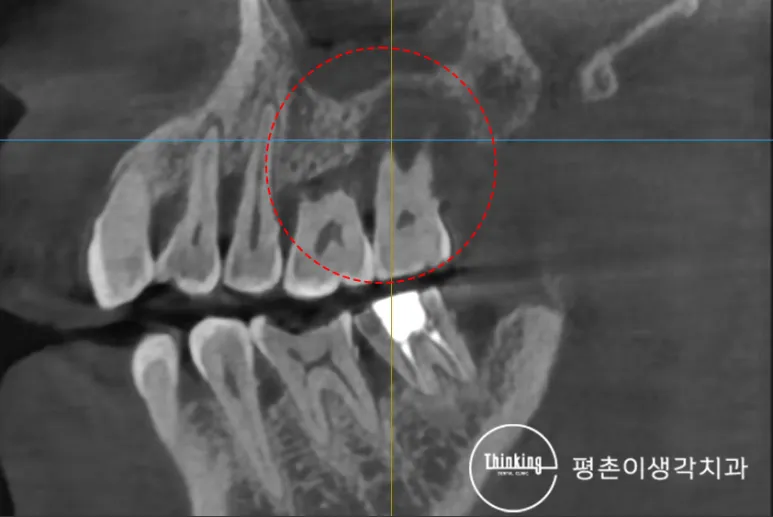 CT 단면 영상에서 위턱 어금니 부위를 빨간 원으로 표시해 뿌리 주변 염증과 상악동 아래 뼈가 소실된 상태를 보여 주는 모습