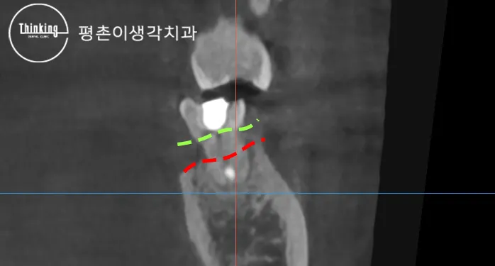 CT 단면 영상에서 위턱 어금니 상악동 바닥을 초록과 빨강 점선으로 나누어 남아 있는 뼈 높이를 보여 주는 모습