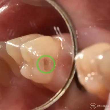 인접한 어금니 씹는 면을 초록 원으로 표시한 근접 구내 사진으로 홈 안쪽이 검게 착색되어 충치가 진행된 모습