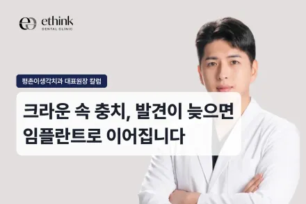 크라운 속 충치, 발견이 늦으면 임플란트로 이어질 수 있습니다