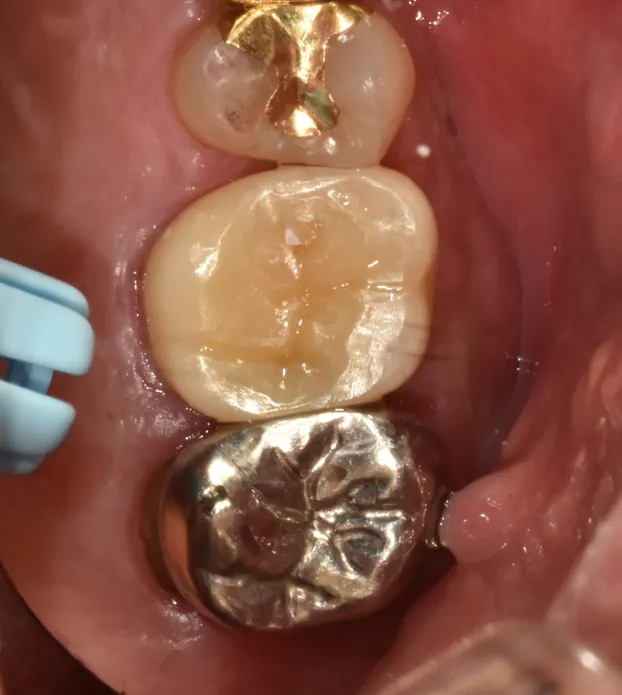 4. 안쪽 치아에 금이 간 경우