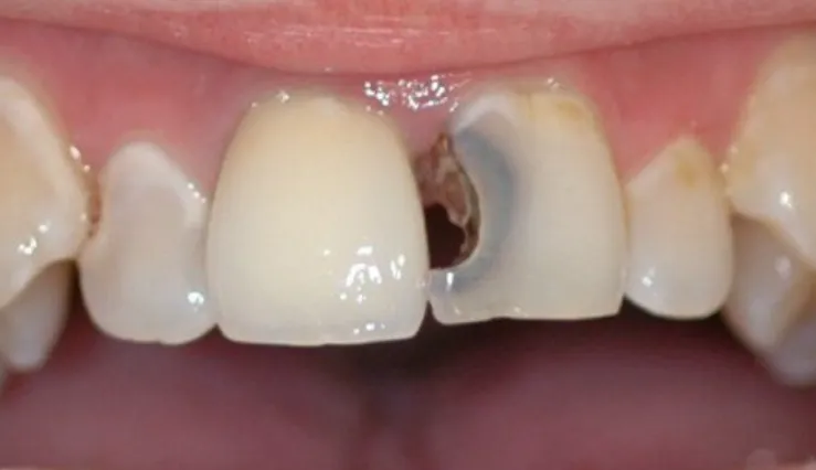 신경치료로 넘어가는 기준