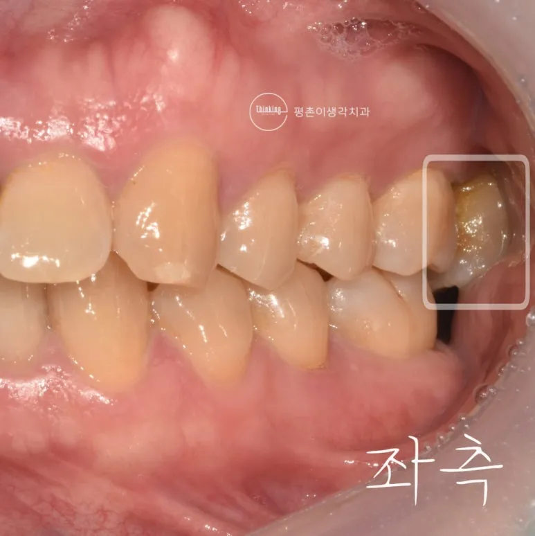 하악 어금니 결손으로 위 어금니가 아래로 내려온 상태를 보여주는 좌측 구치부 측방 구내 사진